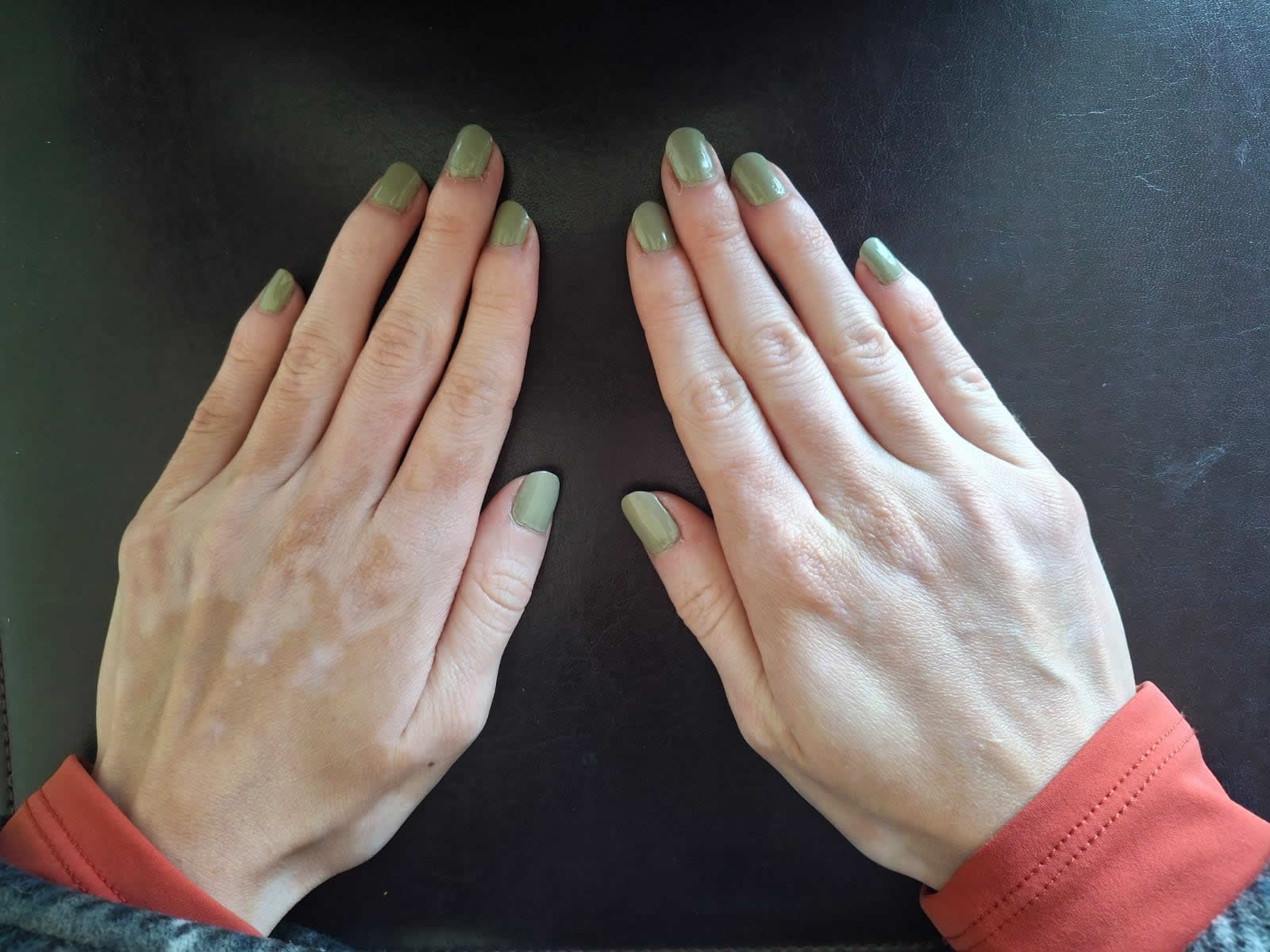 Vitiligo: el camino de sanar sin dejar de amarme